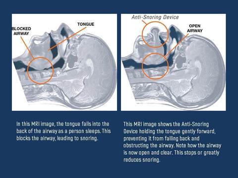 Tongue Stabilizing Device with Medical Grade Silicone and Suction Hold for Sleep