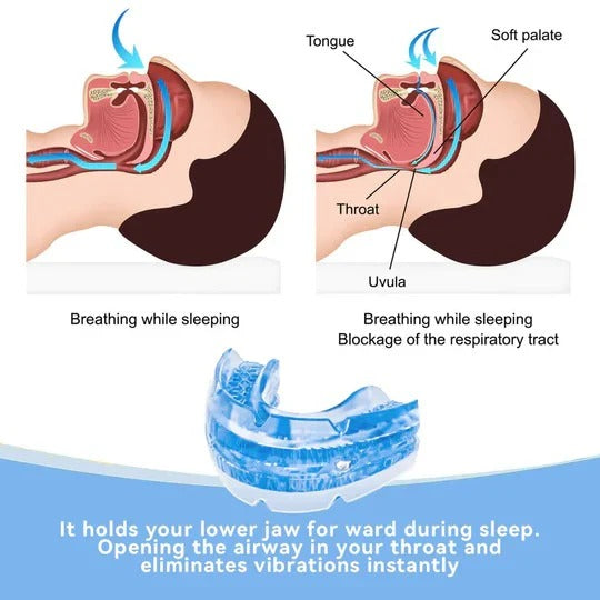 Moldable Anti-Snore Mouthpiece with Screw-Based Jaw Adjustment and Washable Design