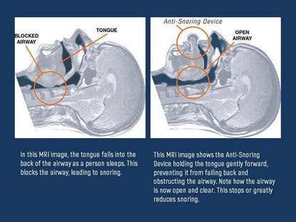 Tongue Stabilizing Device with Medical Grade Silicone and Suction Hold for Sleep